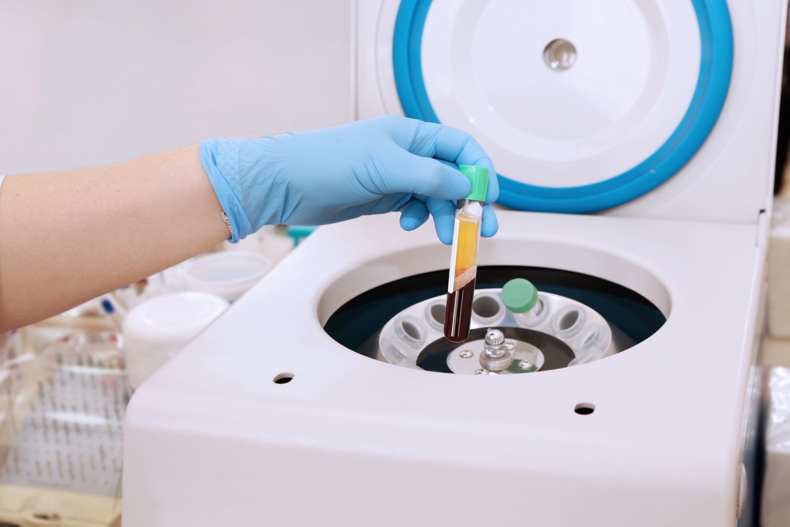 Platelet-rich plasma treatment