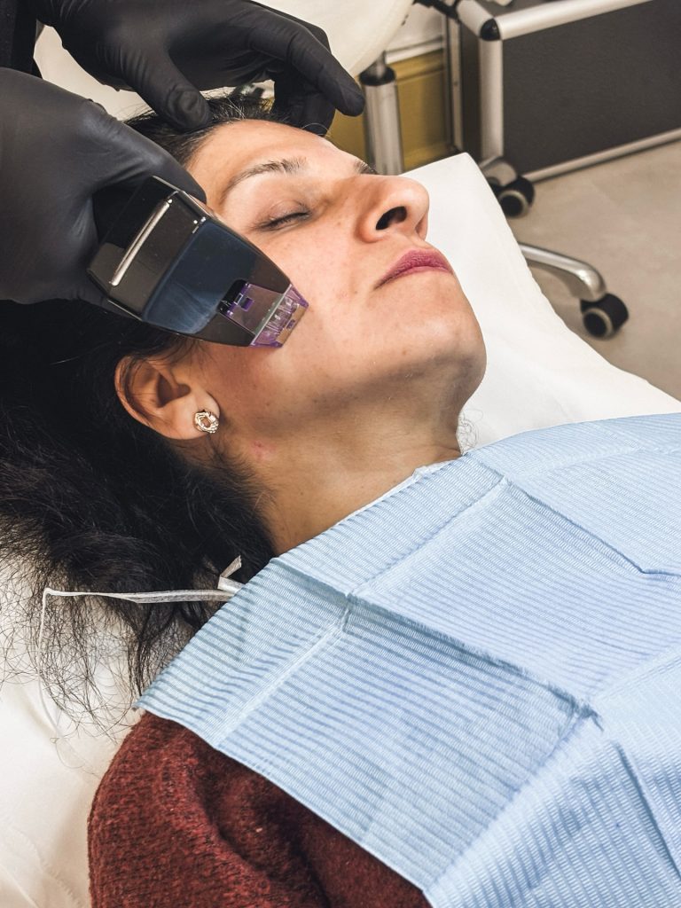RF microneedling treatment at the clinic