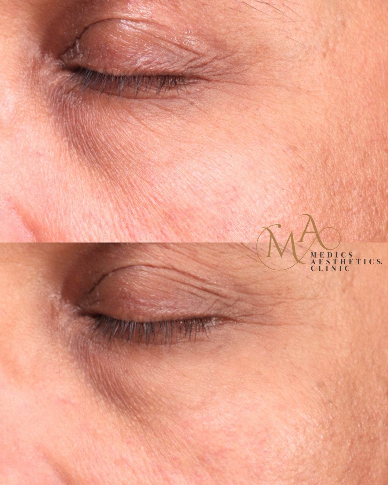 Before and after under-eye results following two polynucleotide sessions