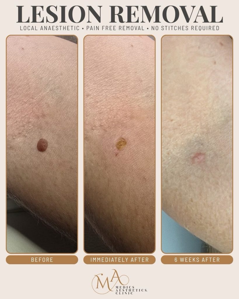 wart lesion removal — Medics Aesthetics