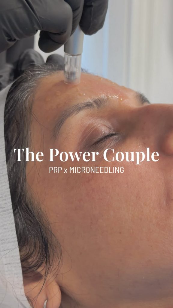 microneedling — Medics Aesthetics