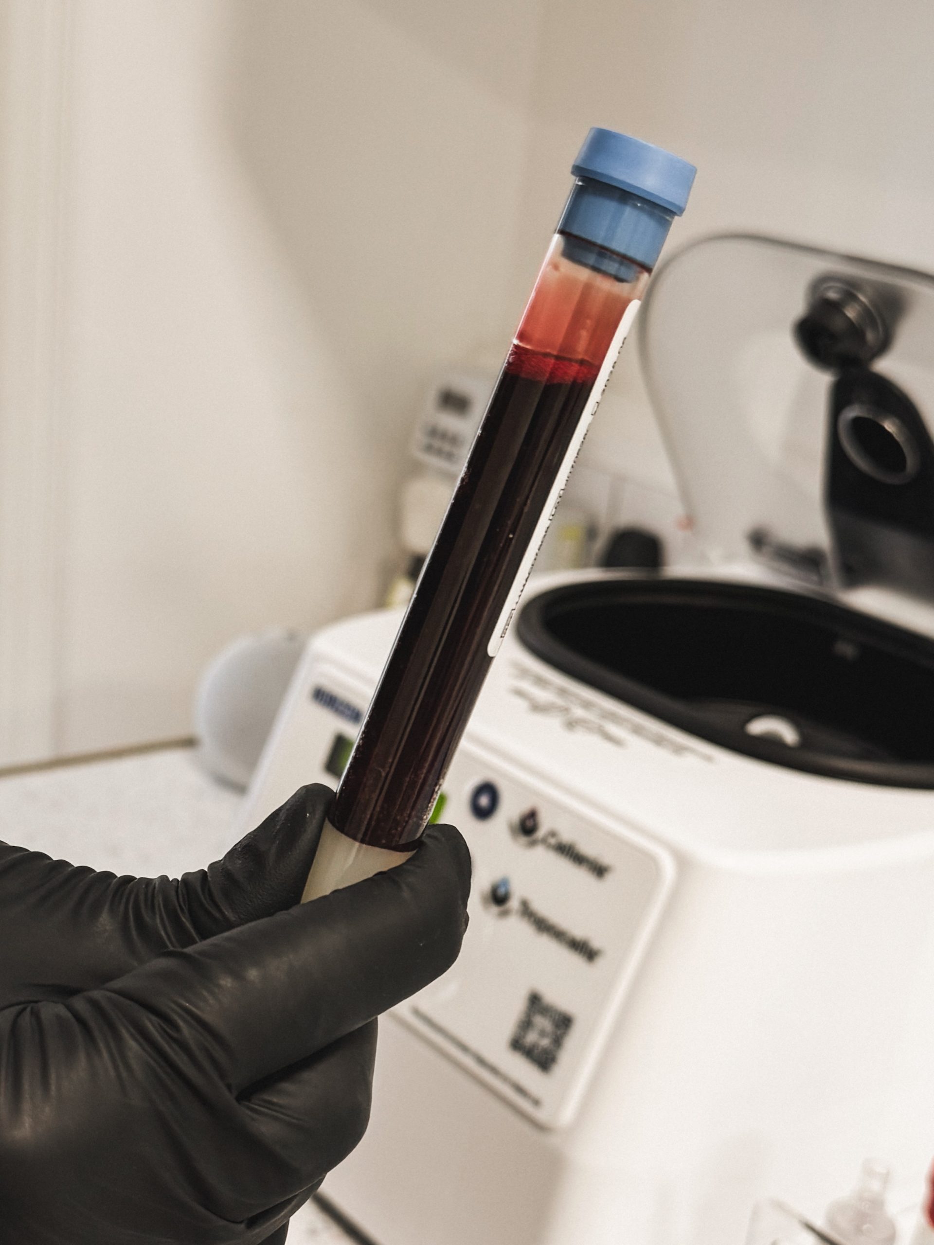 PRP preparation in the clinic